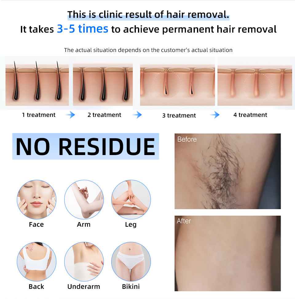 Prezzo di fabbrica 20000000    - Industrial Laser Hair Removal Machine recensione e prezzo